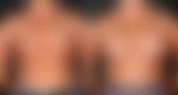Breast Augmentation Before and After Photos in Omaha, NE, Case 5208