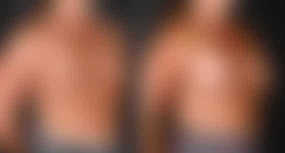 Breast Augmentation Before and After Photos in Omaha, NE, Case 5208