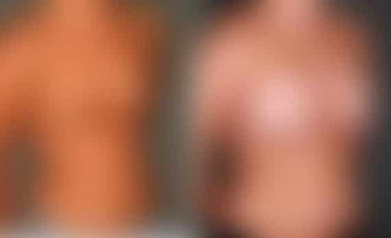 Breast Augmentation Before and After Photos in Omaha, NE, Case 5220