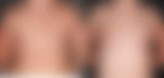 Breast Augmentation Before and After Photos in Omaha, NE, Case 5227