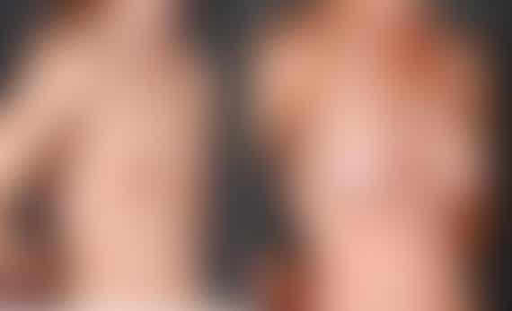 Breast Augmentation Before and After Photos in Omaha, NE, Case 5269