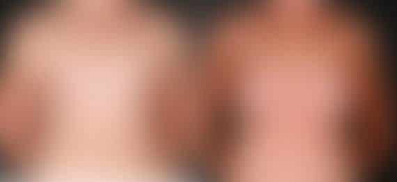 Breast Augmentation Before and After Photos in Omaha, NE, Case 5277