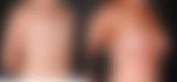 Breast Augmentation Before and After Photos in Omaha, NE, Case 5277
