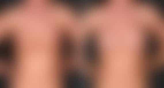 Breast Augmentation Before and After Photos in Omaha, NE, Case 5304