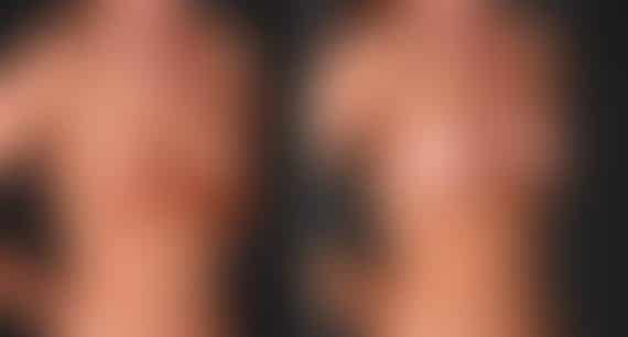 Breast Augmentation Before and After Photos in Omaha, NE, Case 5304