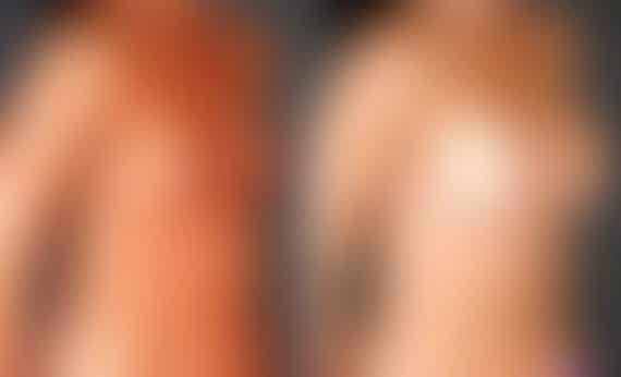Breast Augmentation Before and After Photos in Omaha, NE, Case 5381