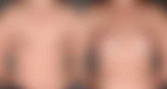 Breast Augmentation Before and After Photos in Omaha, NE, Case 5415