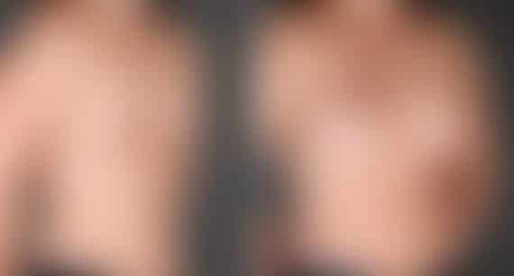Breast Augmentation Before and After Photos in Omaha, NE, Case 5415