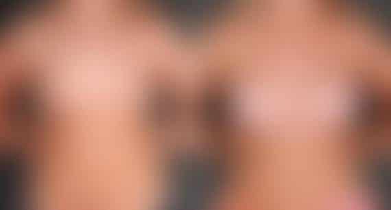 Breast Augmentation Before and After Photos in Omaha, NE, Case 5436