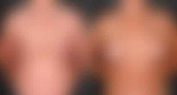Breast Augmentation Before and After Photos in Omaha, NE, Case 5451