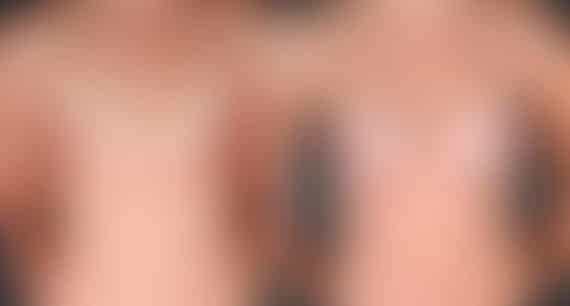 Breast Augmentation Before and After Photos in Omaha, NE, Case 5464