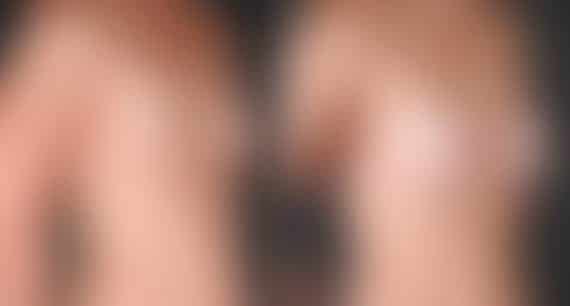 Breast Augmentation Before and After Photos in Omaha, NE, Case 5464
