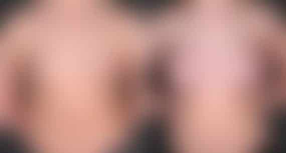 Breast Augmentation Before and After Photos in Omaha, NE, Case 5487
