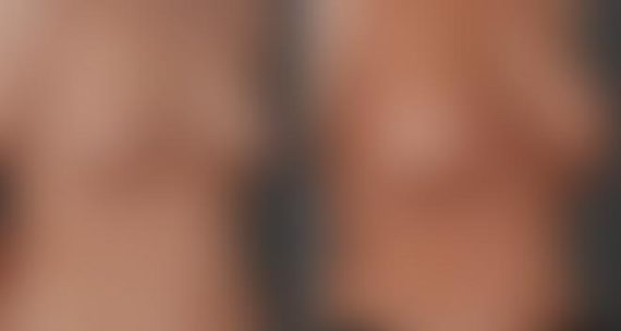 Breast Augmentation Before and After Photos in Omaha, NE, Case 5495