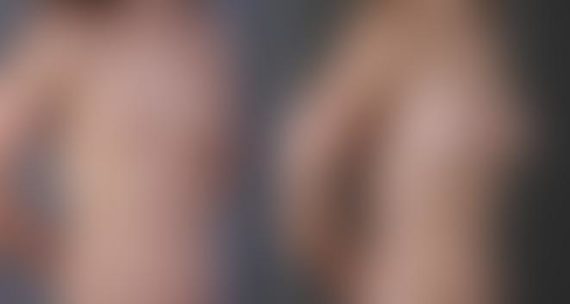 Breast Augmentation Before and After Photos in Omaha, NE, Case 5503