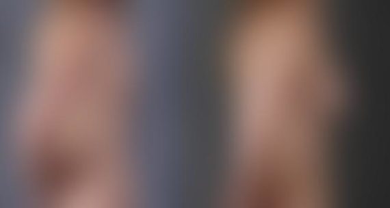 Breast Augmentation Before and After Photos in Omaha, NE, Case 5503
