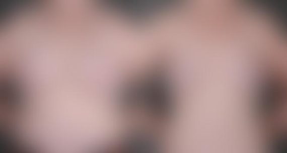 Breast Lift Before and After Photos in Omaha, NE, Case 5571