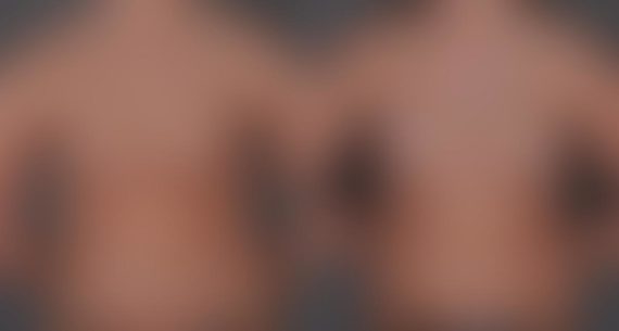 Breast Augmentation Before and After Photos in Omaha, NE, Case 8624