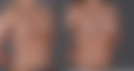 Breast Augmentation Before and After Photos in Omaha, NE, Case 8624