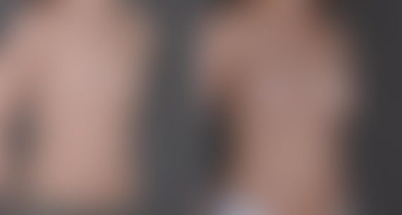 Breast Augmentation Before and After Photos in Omaha, NE, Case 8638
