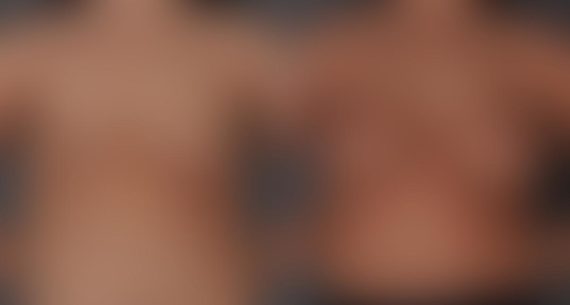 Breast Augmentation Before and After Photos in Omaha, NE, Case 8701