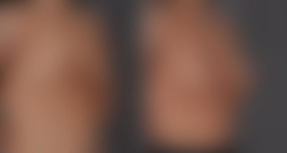 Breast Augmentation Before and After Photos in Omaha, NE, Case 8701