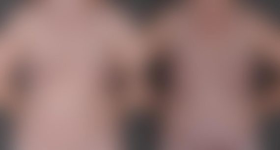 Breast Augmentation Before and After Photos in Omaha, NE, Case 8739