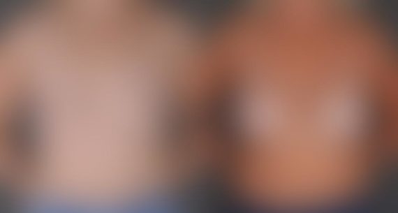 Breast Augmentation Before and After Photos in Omaha, NE, Case 8757