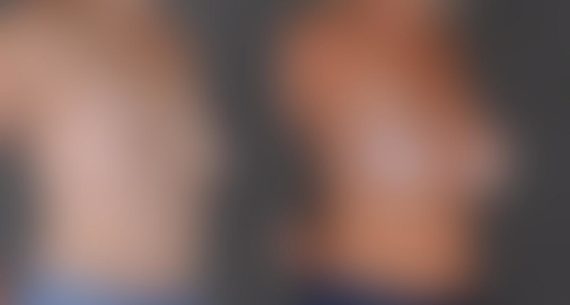 Breast Augmentation Before and After Photos in Omaha, NE, Case 8757