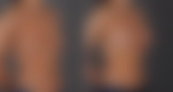 Breast Augmentation Before and After Photos in Omaha, NE, Case 8764
