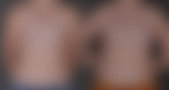 Breast Augmentation Before and After Photos in Omaha, NE, Case 8771