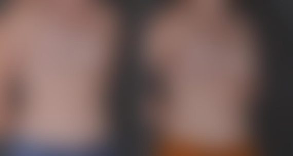 Breast Augmentation Before and After Photos in Omaha, NE, Case 8771