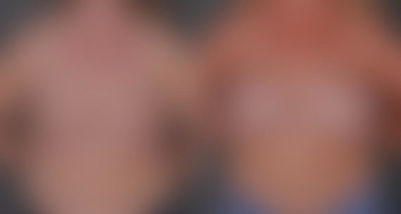 Breast Augmentation Before and After Photos in Omaha, NE, Case 8778