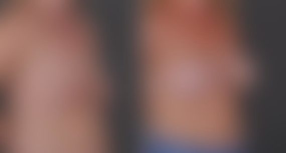 Breast Augmentation Before and After Photos in Omaha, NE, Case 8778