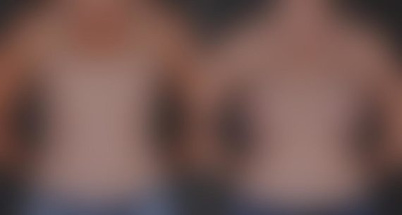 Breast Augmentation Before and After Photos in Omaha, NE, Case 8795