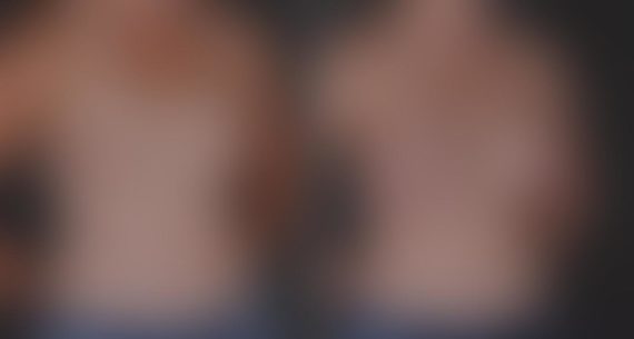 Breast Augmentation Before and After Photos in Omaha, NE, Case 8795