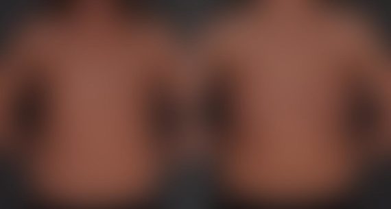 Breast Augmentation Before and After Photos in Omaha, NE, Case 8813