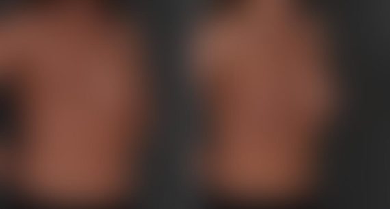 Breast Augmentation Before and After Photos in Omaha, NE, Case 8813