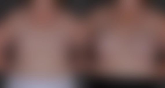 Breast Augmentation Before and After Photos in Omaha, NE, Case 8814