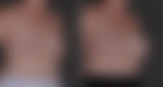 Breast Augmentation Before and After Photos in Omaha, NE, Case 8814