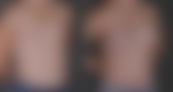 Breast Augmentation Before and After Photos in Omaha, NE, Case 8868