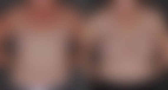 Breast Augmentation Before and After Photos in Omaha, NE, Case 8875
