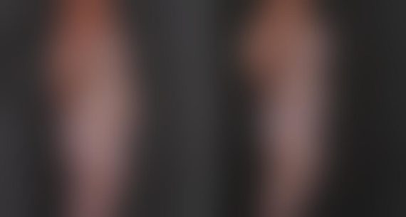Breast Augmentation Before and After Photos in Omaha, NE, Case 8911