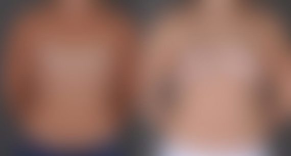 Breast Augmentation Before and After Photos in Omaha, NE, Case 8920
