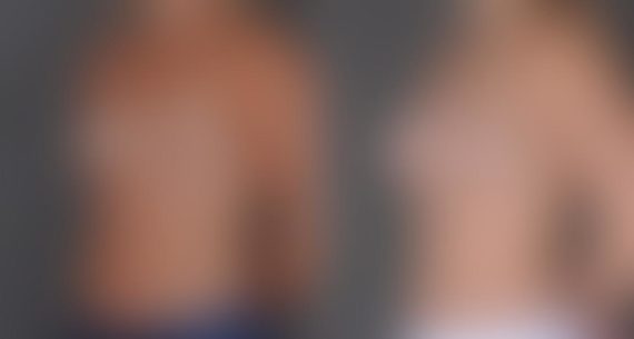 Breast Augmentation Before and After Photos in Omaha, NE, Case 8920