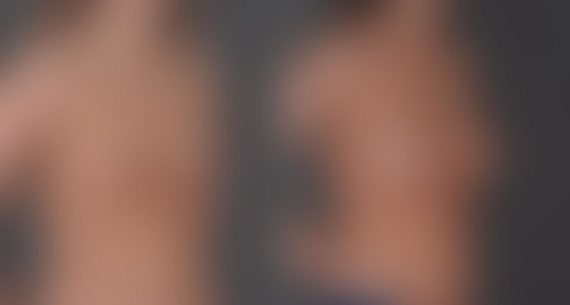 Breast Augmentation Before and After Photos in Omaha, NE, Case 8927
