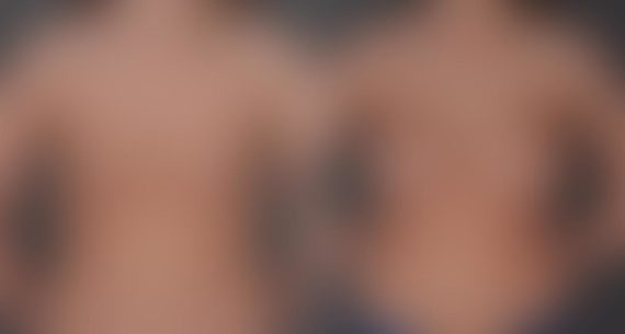 Breast Augmentation Before and After Photos in Omaha, NE, Case 8927
