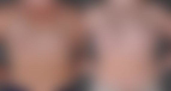 Breast Augmentation Before and After Photos in Omaha, NE, Case 8934