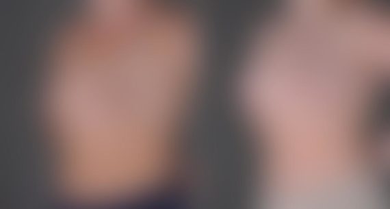 Breast Augmentation Before and After Photos in Omaha, NE, Case 8934