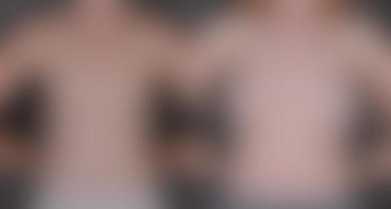 Breast Augmentation Before and After Photos in Omaha, NE, Case 8951